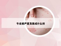 牛皮癣严重发展成什么样