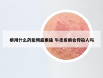 癣用什么药能彻底根除 牛皮皮癣会传染人吗