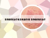 生物制剂治疗有没有副作用 生物制剂的治疗