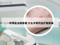 一种草能治银屑病 什么中草药治疗银屑病