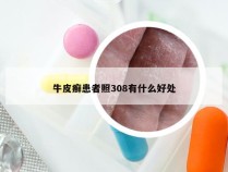 牛皮癣患者照308有什么好处