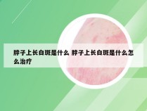 脖子上长白斑是什么 脖子上长白斑是什么怎么治疗