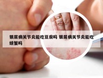 银屑病关节炎能吃豆腐吗 银屑病关节炎能吃螃蟹吗