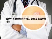 皮肤ct提示银屑病样增生 表皮呈银屑病样增生