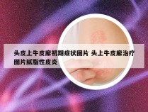 头皮上牛皮廨初期症状图片 头上牛皮廨治疗图片腻脂性皮炎