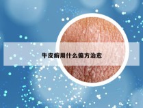 牛皮癣用什么偏方治愈