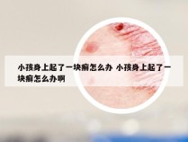 小孩身上起了一块癣怎么办 小孩身上起了一块癣怎么办啊