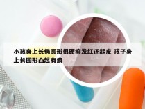 小孩身上长椭圆形很硬癣发红还起皮 孩子身上长圆形凸起有癣