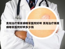 贵阳治疗银屑病哪家医院好啊 贵阳治疗银屑病哪家医院好啊多少钱