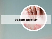 th2银屑病 银屑病th17