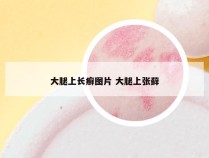 大腿上长癣图片 大腿上张藓