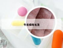 牛皮癣和毛发