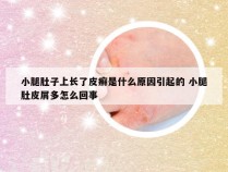 小腿肚子上长了皮癣是什么原因引起的 小腿肚皮屑多怎么回事