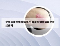 全身红皮型银屑病图片 红皮型银屑病是全身红皮吗