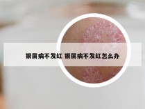 银屑病不发红 银屑病不发红怎么办