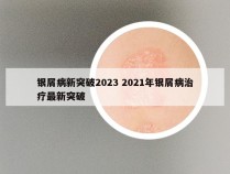 银屑病新突破2023 2021年银屑病治疗最新突破