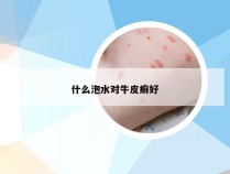 什么泡水对牛皮癣好