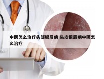 中医怎么治疗头部银屑病 头皮银屑病中医怎么治疗