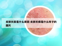 皮肤长藓是什么原因 皮肤长癣是什么样子的图片