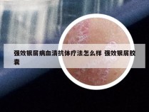 强效银屑病血清抗体疗法怎么样 强效银屑胶囊