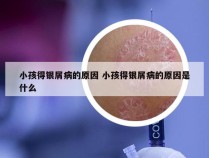 小孩得银屑病的原因 小孩得银屑病的原因是什么