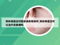 周林频谱仪对银屑病有帮助吗 周林频谱仪可以治疗皮肤病吗