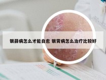 银薛病怎么才能自愈 银霄病怎么治疗比较好