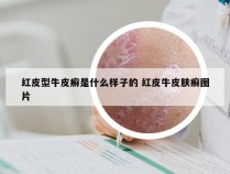 红皮型牛皮癣是什么样子的 红皮牛皮肤癣图片