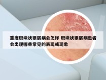 重度斑块状银屑病会怎样 斑块状银屑病患者会出现哪些常见的表现或现象