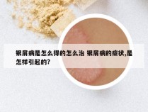 银屑病是怎么得的怎么治 银屑病的症状,是怎样引起的?