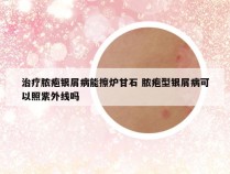 治疗脓疱银屑病能擦炉甘石 脓疱型银屑病可以照紫外线吗