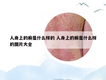 人身上的癣是什么样的 人身上的癣是什么样的图片大全