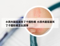 小孩大腿后面长了个圆形癣 小孩大腿后面长了个圆形癣怎么回事