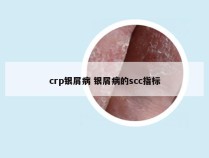 crp银屑病 银屑病的scc指标