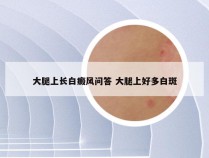 大腿上长白癜风问答 大腿上好多白斑