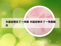 大腿后侧长了一块癣 大腿后侧长了一块癣图片