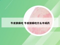 牛皮肤癣吃 牛皮肤癣吃什么中成药