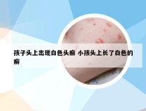 孩子头上出现白色头癣 小孩头上长了白色的癣