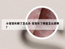 小宝宝长癣了怎么办 宝宝长了癣是怎么回事?