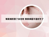 银屑病厉害了会怎样 银屑病是不是好不了