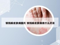 铜钱癣皮肤病图片 铜钱癣皮肤病用什么药膏