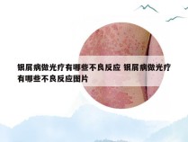 银屑病做光疗有哪些不良反应 银屑病做光疗有哪些不良反应图片