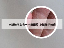 小腿肚子上有一个癣图片 小腿肚子长癣