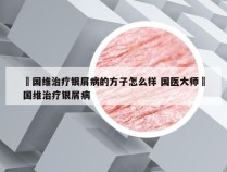 禤国维治疗银屑病的方子怎么样 国医大师禤国维治疗银屑病