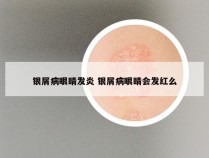 银屑病眼睛发炎 银屑病眼睛会发红么