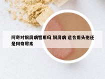 阿奇对银屑病管用吗 银屑病 适合用头孢还是阿奇霉素