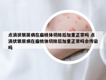 点滴状银屑病在扁桃体切除后加重正常吗 点滴状银屑病在扁桃体切除后加重正常吗会传染吗