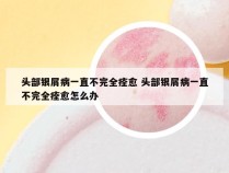 头部银屑病一直不完全痊愈 头部银屑病一直不完全痊愈怎么办