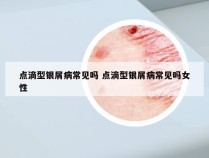 点滴型银屑病常见吗 点滴型银屑病常见吗女性