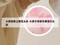 小孩皮肤上癣怎么办 小孩子皮肤长癣涂什么药